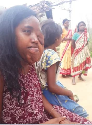 Jadugoda uranium pollution
